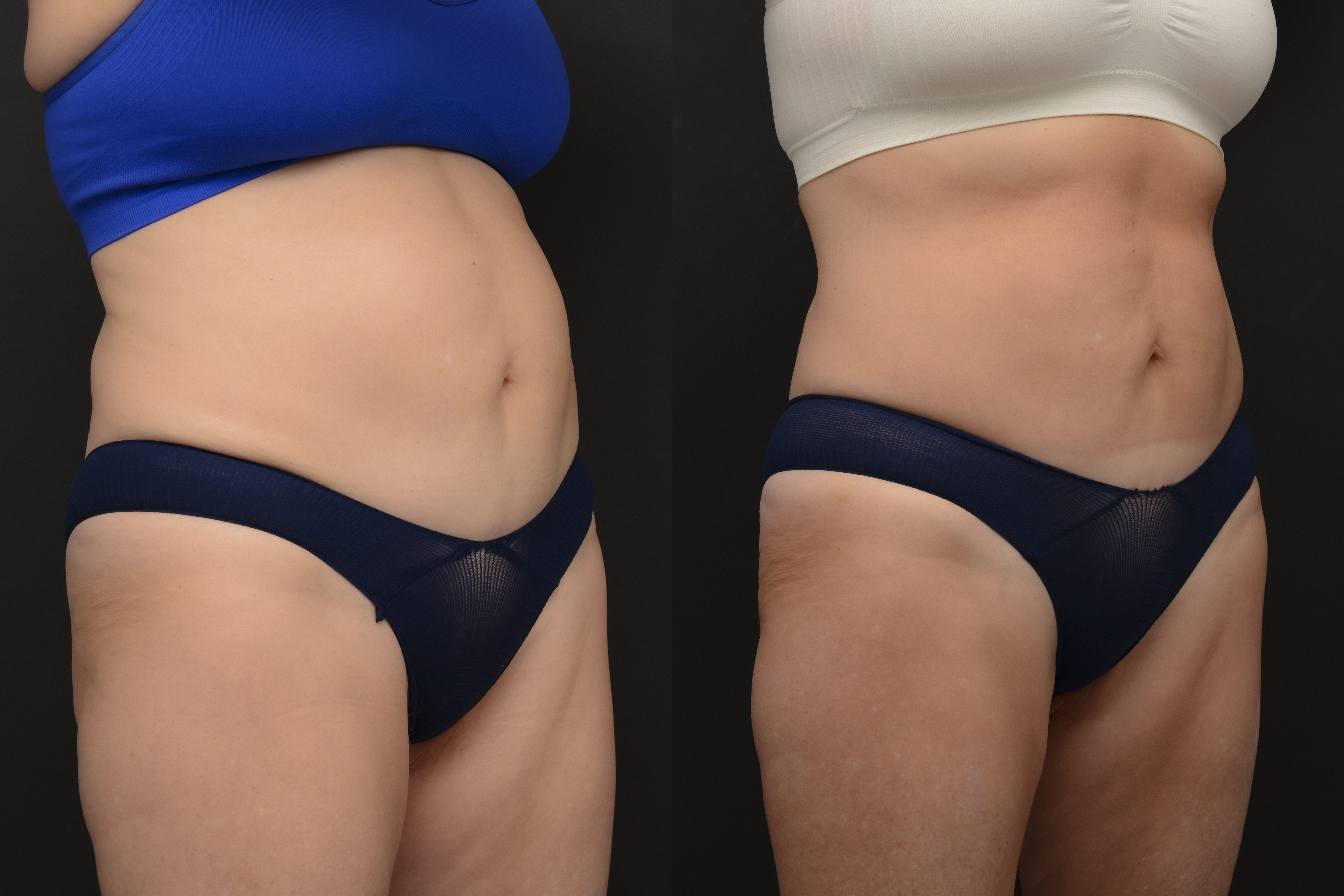Emsculpt abdomen transformation - before and after